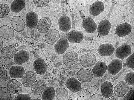 Устойчивую к антибиотикам микобактериальную легочную инфекцию смогли победить с помощью бактериофагов