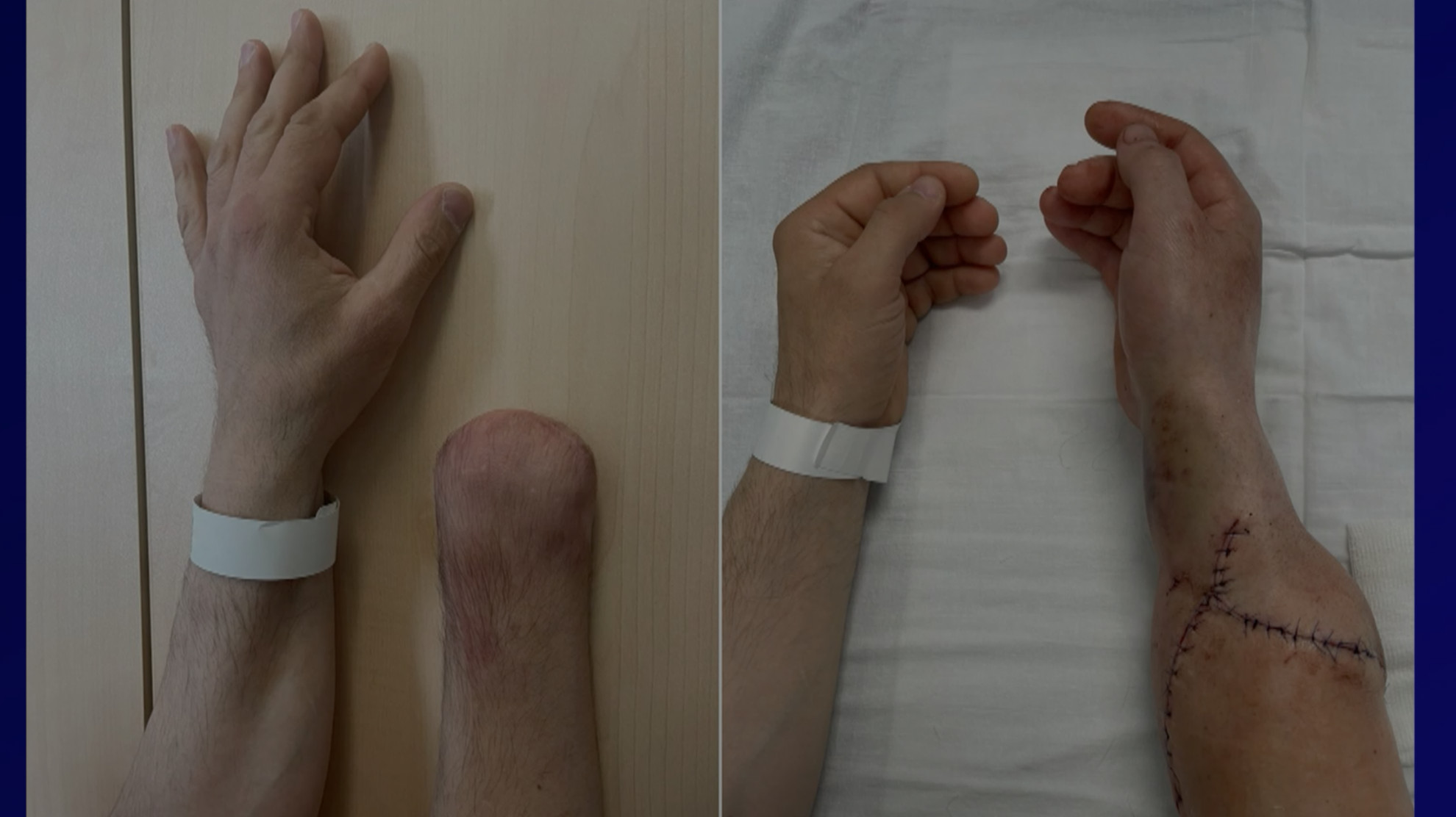 Первую в России пересадку обеих кистей рук от донора провели в НИИ им. Склифосовского